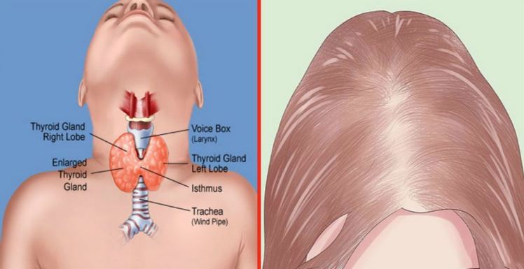ارتباط تیروئید با مو و تراپی